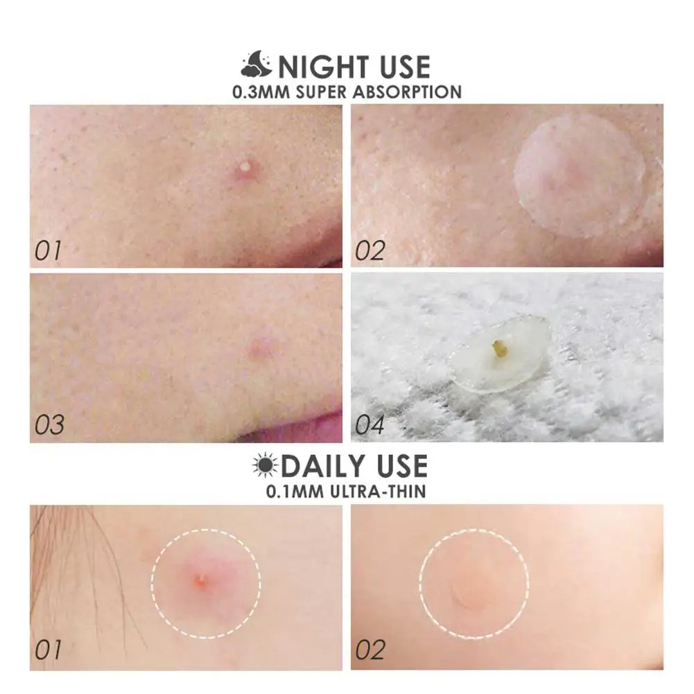 36 Patches Acne Pimple Patch Face Invisible Stickers Quick Effect Treatment Removing Patches Beauty Acne Tools Face Skin Care
